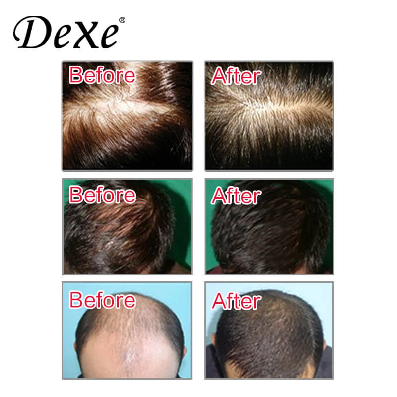 Original Dexe Hair Shampoo Anti Hair Loss