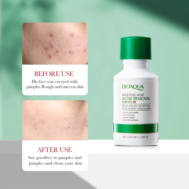 Bioaqua Salicylic Acid Acne Removal Essence Serum 35ml